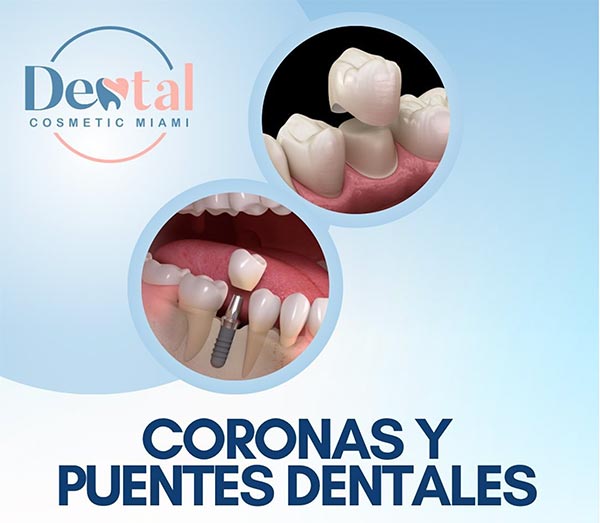 Coronas Dentales - Dental Cosmetic Miami